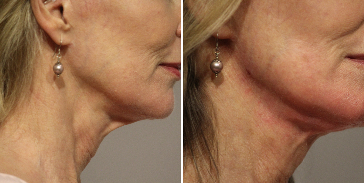 Neck Thread Lift Face and Eye Aesthetics