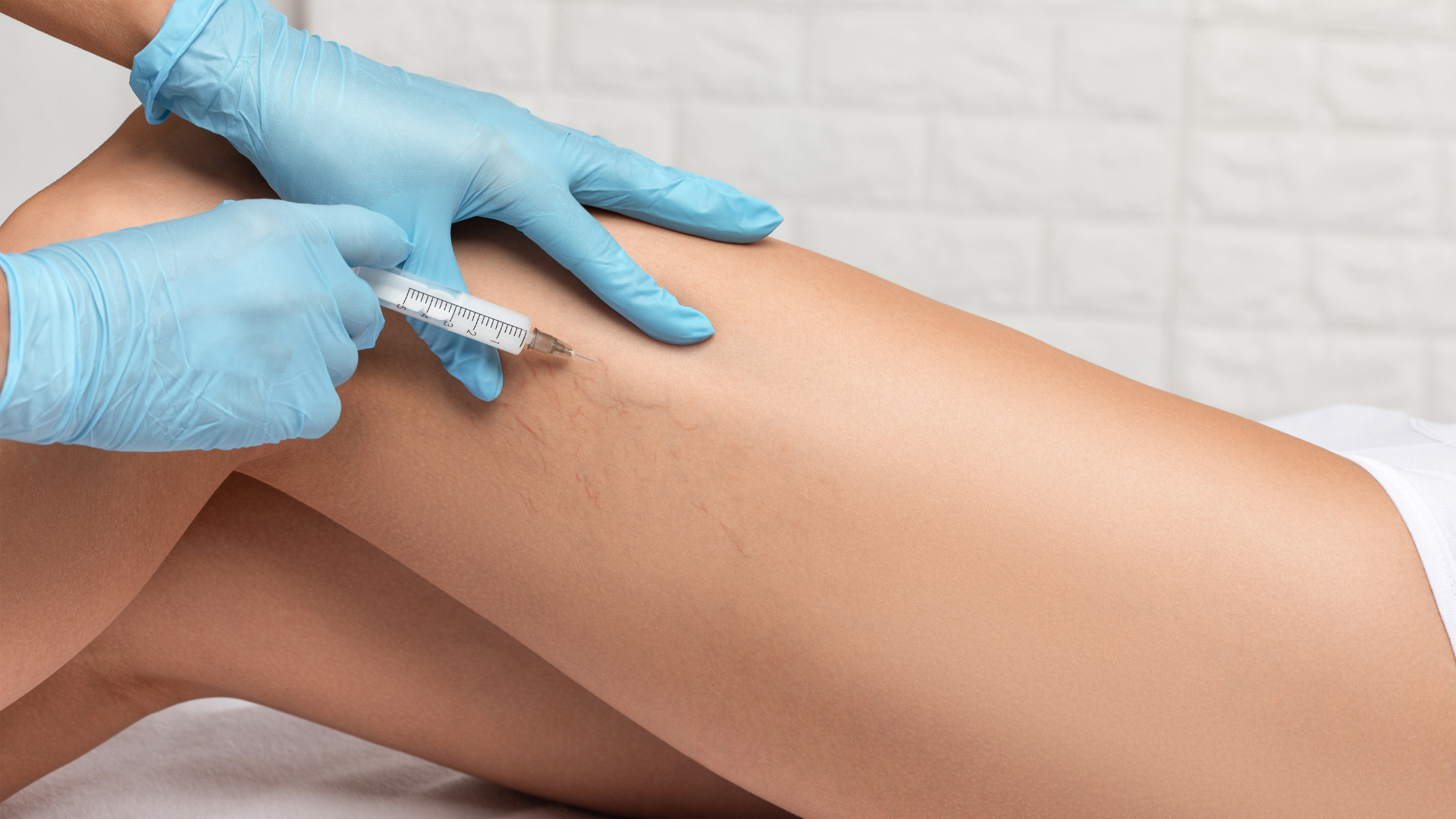 Vein Removal Photo