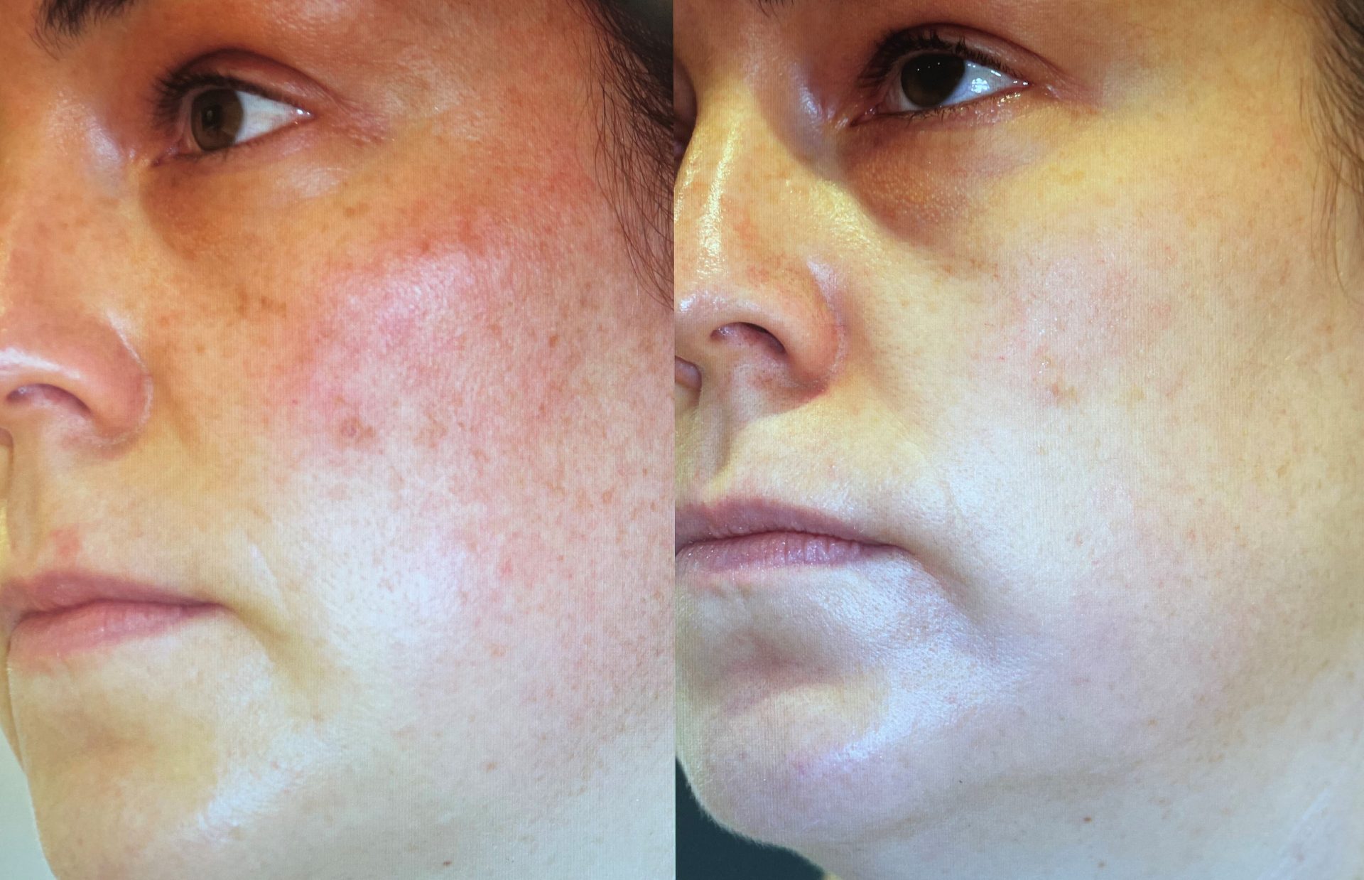 Rosacea